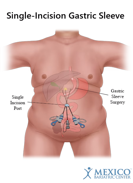 Single incision gastric sleeve